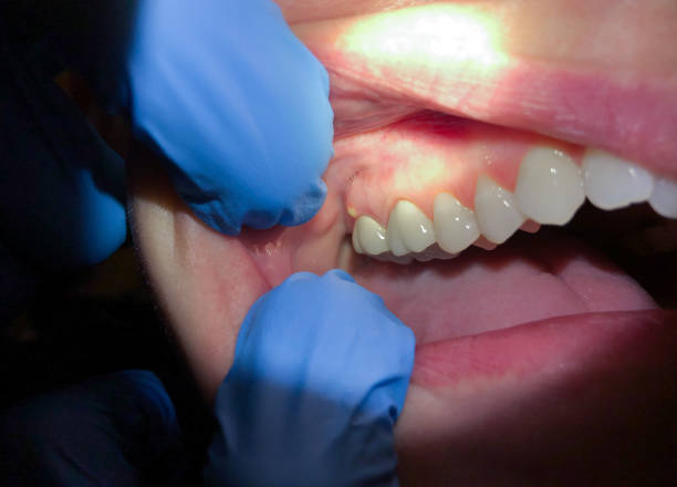 Best Emergency Dentist for Knocked-Out Tooth in Clarence, IA